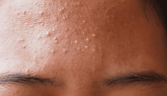 fungal-acne-treatment-with-affordable-and-homemade-products-how-to