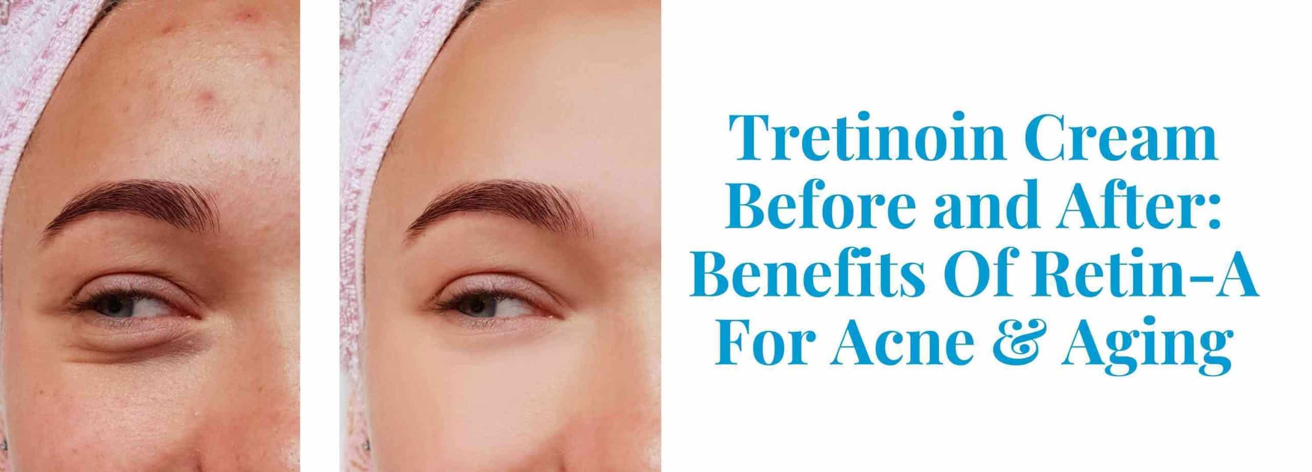 Tretinoin Before And After Benefits Of Retin A Pandia Health