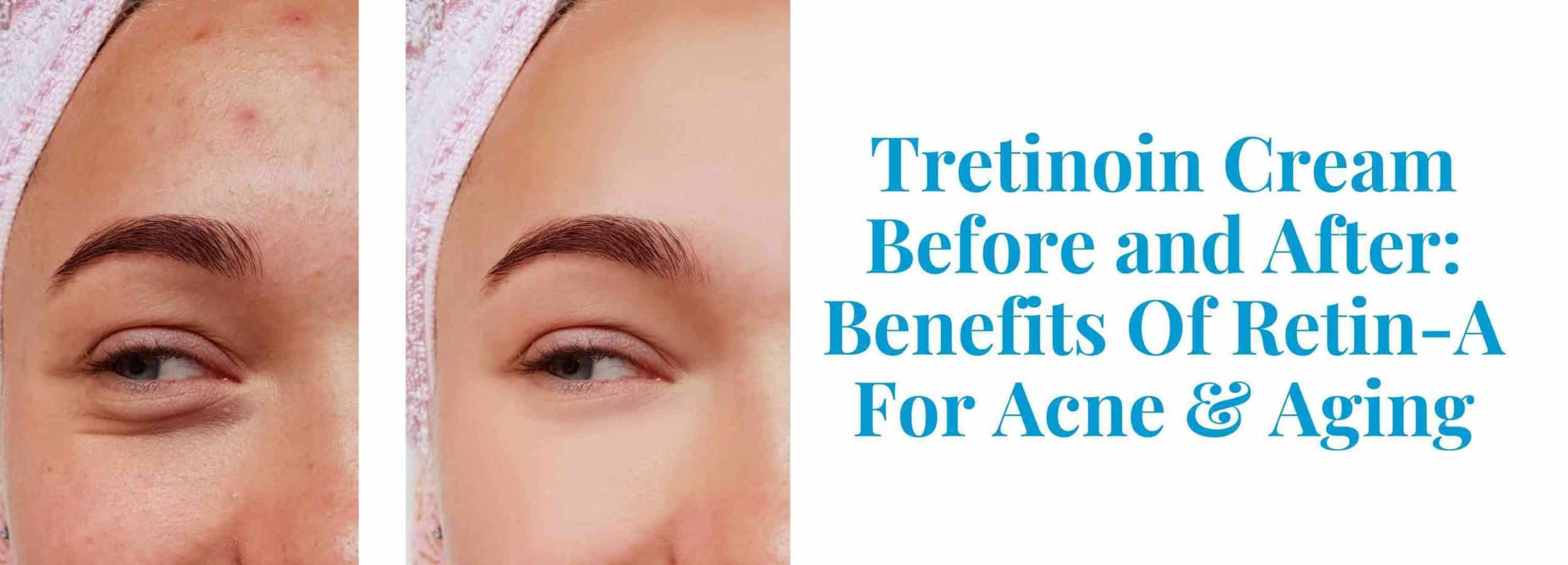 Tretinoin Before After Benefits Of Retin A Pandia Health