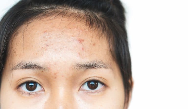 what-causes-forehead-acne-and-how-to-get-rid-of-it