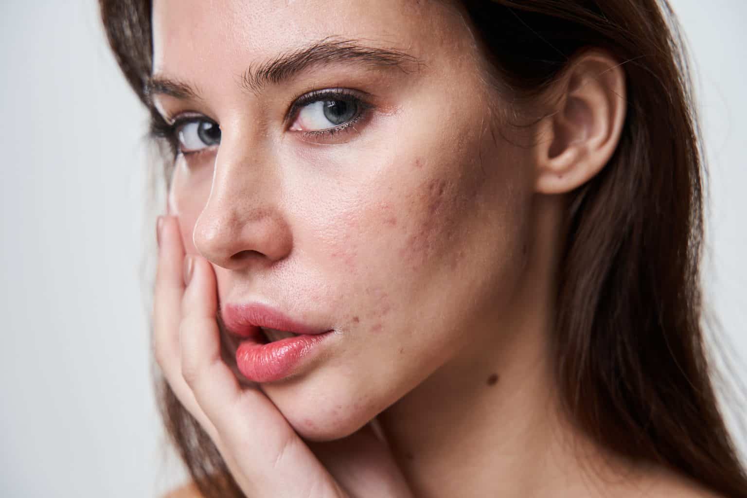 acne-scars-treatment-dublin-at-minnie-tinkham-blog