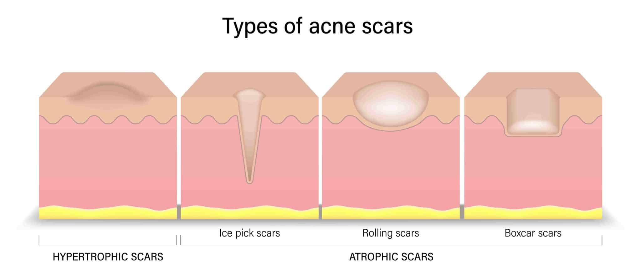 How To Prevent Acne Scars: Causes & Treatments | Pandia Health