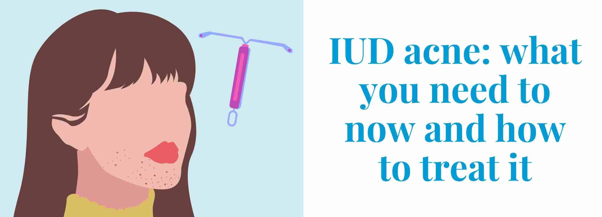 IUD Acne: How IUD's Can Cause Acne, And How To Treat It